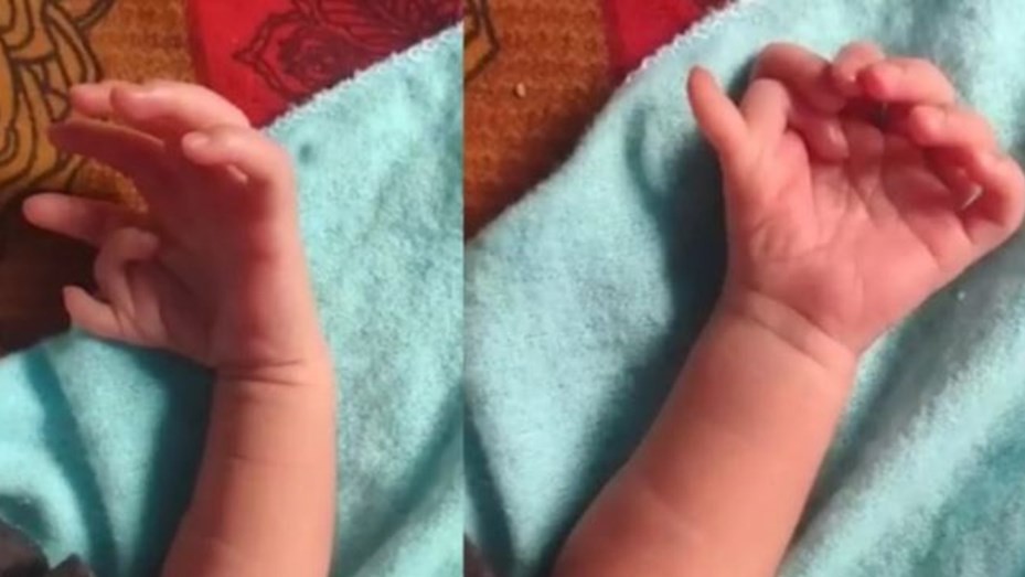 Una beba nació con 7 dedos en cada mano y 6 en cada pie
