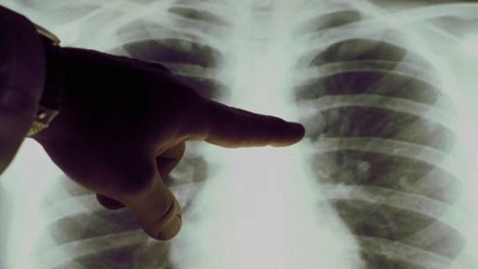 Presentan en la Argentina un nuevo tratamiento para un tipo de cáncer de pulmón